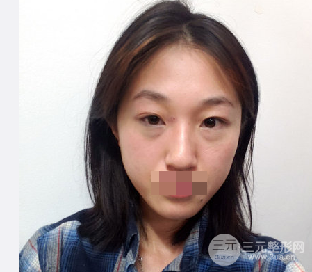 抽脂去眼袋手术的利弊