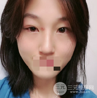 抽脂去眼袋手术的利弊