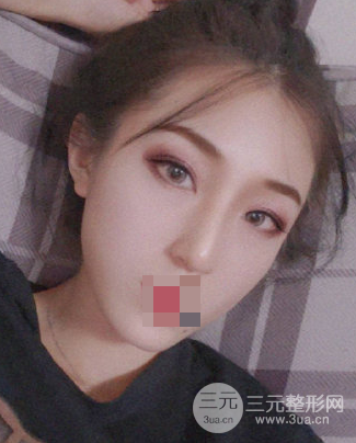 抽脂去眼袋手术的利弊