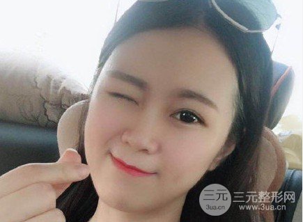 玻尿酸隆鼻成好吗