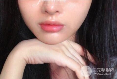 微整形案例