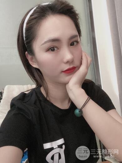双眼皮手术案例