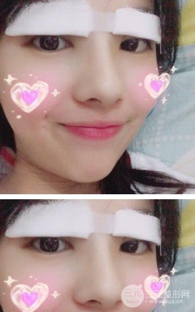 开眼角前后对比照片图集，来看看真实的果是否理想吧！