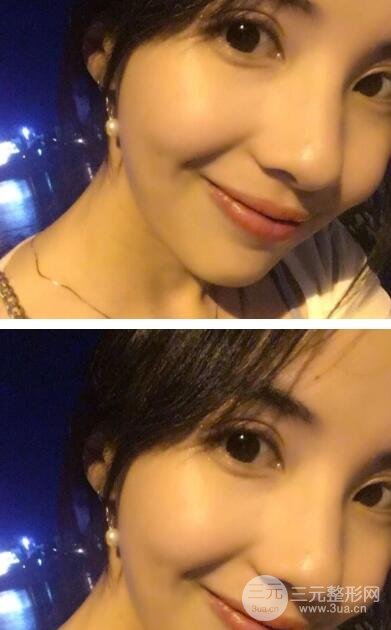 开眼角手术之前