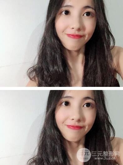 开眼角手术结束后