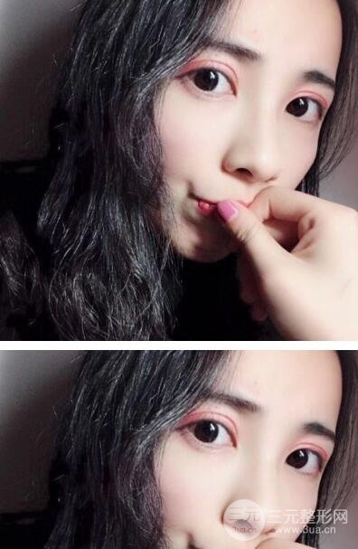 开眼角手术结束后