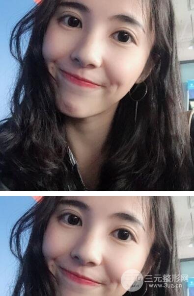 开眼角手术结束后