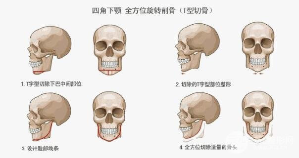 微创改脸型