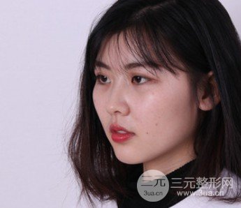 玻尿酸隆鼻对比图