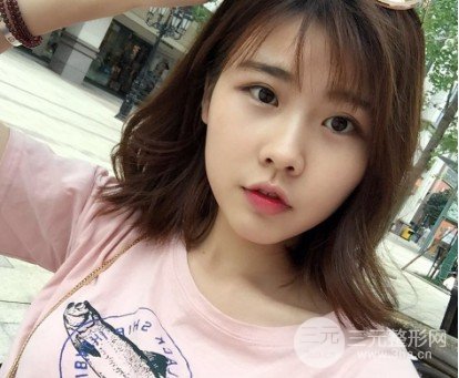 玻尿酸隆鼻对比图