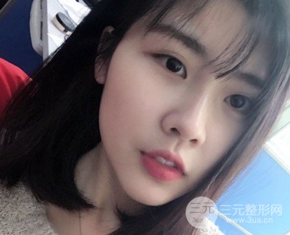 玻尿酸隆鼻对比图