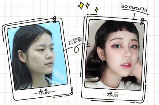假体隆鼻要注意什么