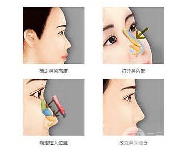假体隆鼻要注意什么