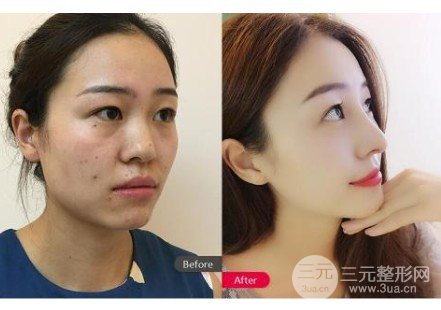 哪种隆鼻术好