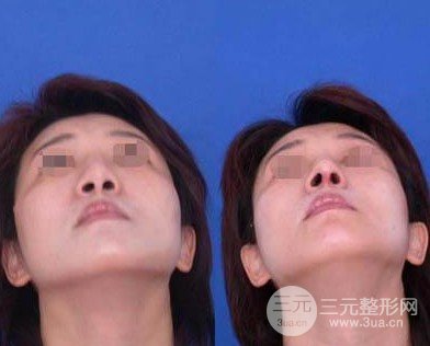 哪种隆鼻术好
