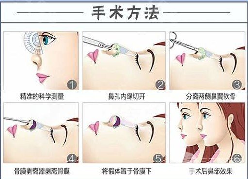 哪种隆鼻术好