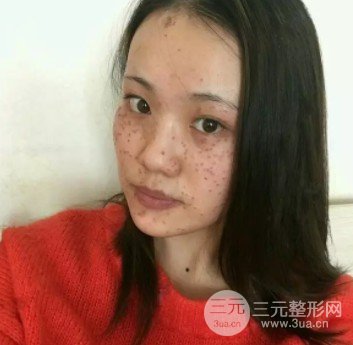 激光雀斑价格多少
