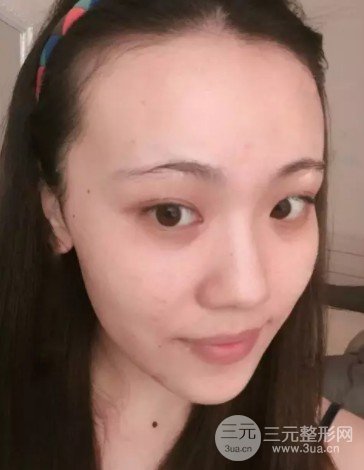 激光雀斑价格多少