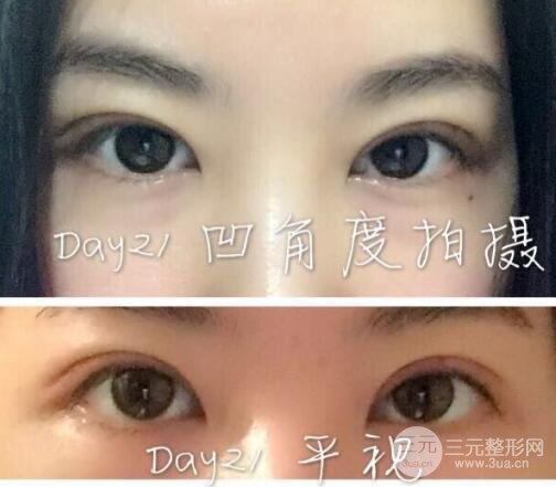 8毫米双眼皮恢复了多宽
