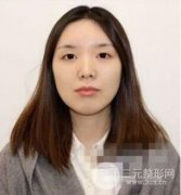 脂肪填充下巴还没恢复好丑！熬过恢复期美如画