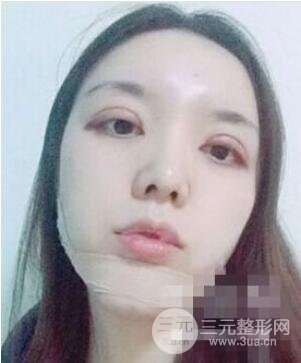 脂肪填充下巴还没恢复好丑