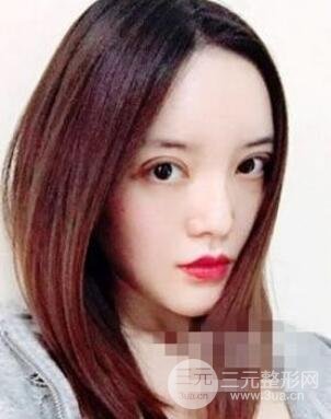 脂肪填充下巴还没恢复好丑