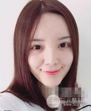 脂肪填充下巴果图