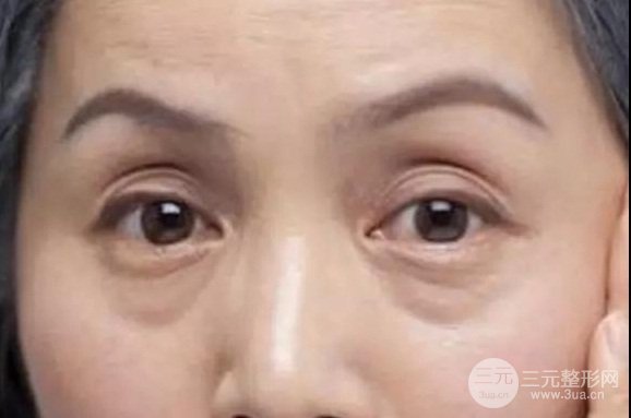 其实假性眼袋还是较为常见的,很多人都有假性眼袋