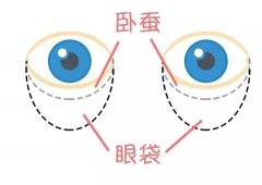 假性眼袋什么样子，图片来教你如何解决不同类型的眼袋！