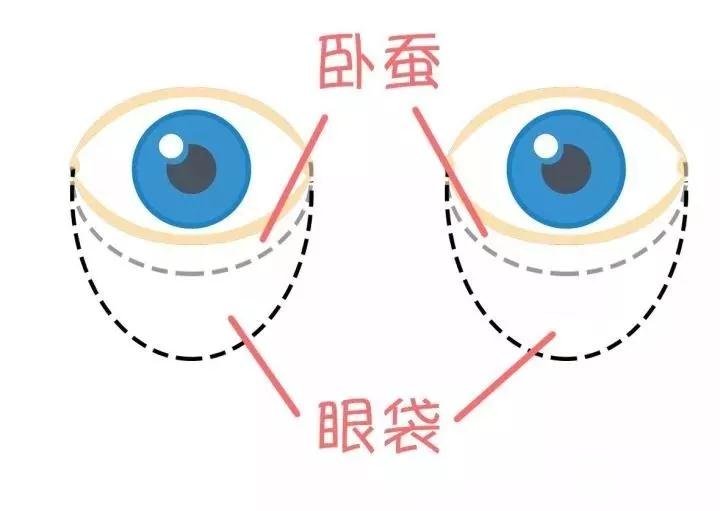 假性眼袋什么样子图