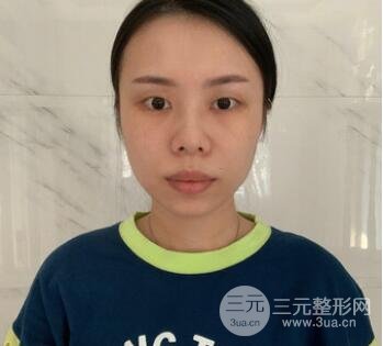 埋线20天恢复图高清照,埋线双眼皮案例果!