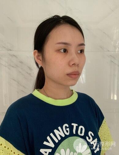 埋线手术之前