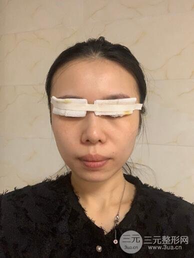 埋线手术之前