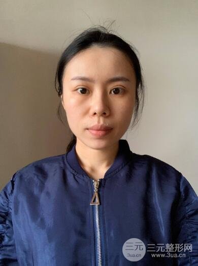 埋线手术结束后