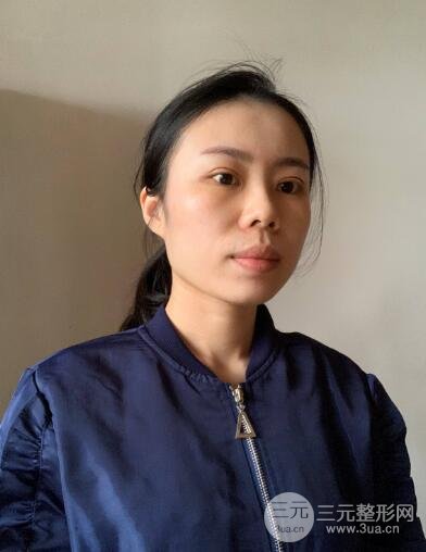 埋线手术一周后