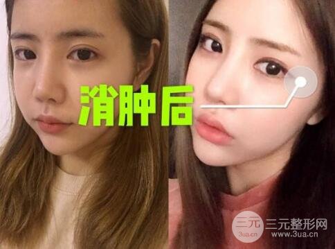 埋线好还是纳米微创好?