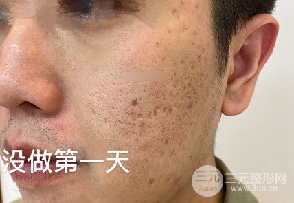 像素激光祛痘坑