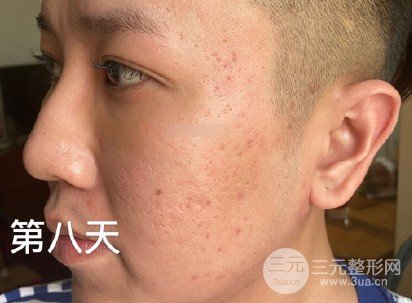 像素激光祛痘坑