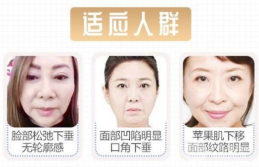 面部除皱果如何