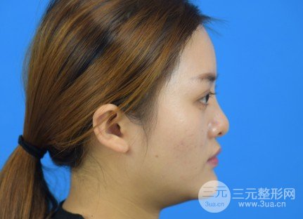玻尿酸注射隆鼻的果