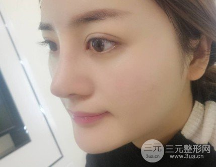 玻尿酸注射隆鼻的果