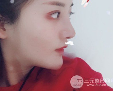 玻尿酸注射隆鼻的果