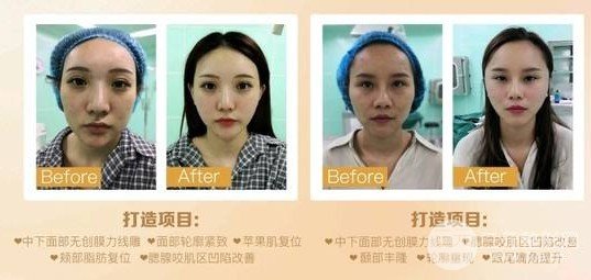 面部除皱果如何
