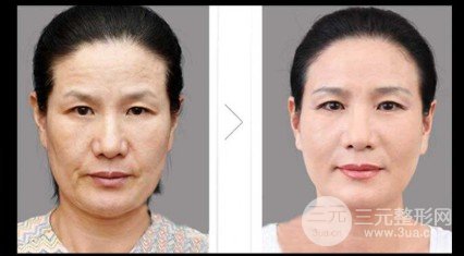 面部除皱果如何
