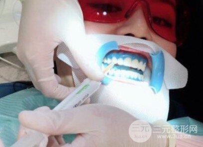 冷光美白牙齿的价格