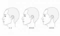 磨骨手术对比照片，再也没有人叫我大脸猫了