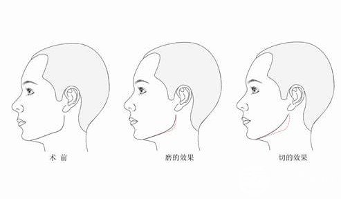 磨骨手术对比照片