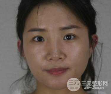 吴慧玲双眼皮修复经历