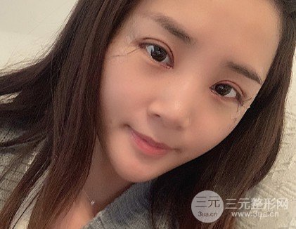 吴慧玲双眼皮修复经历
