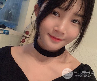 吴慧玲双眼皮修复经历